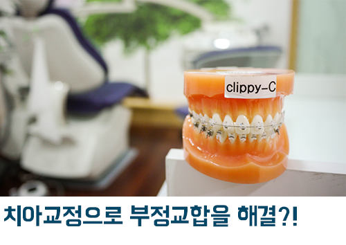 부정교합 치아교정으로 치료할 수 있다?! 관련 이미지 3
