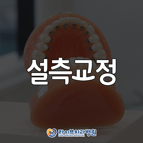 설측교정 무엇을 알아봐야할까? 관련 이미지 1