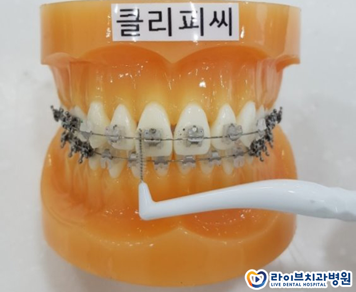 치아교정 양치질 어떻게 해야할까 관련 이미지 4