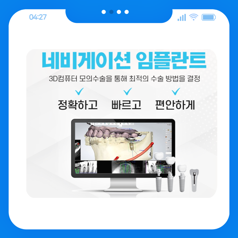 네비게이션임플란트 꼼꼼한 치료가 필요할 때 관련 이미지 3