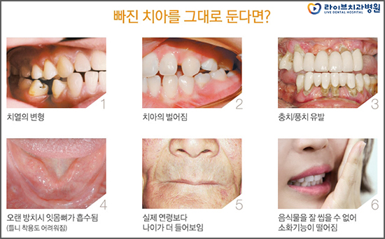 어금니임플란트 가격 찾아보고 있다면 관련 이미지 2