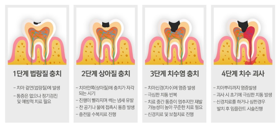 인천충치치료 잘하는 일요일치과는 어디? 관련 이미지 4