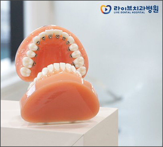 치아교정장치 차이점을 비교해보자 관련 이미지 4