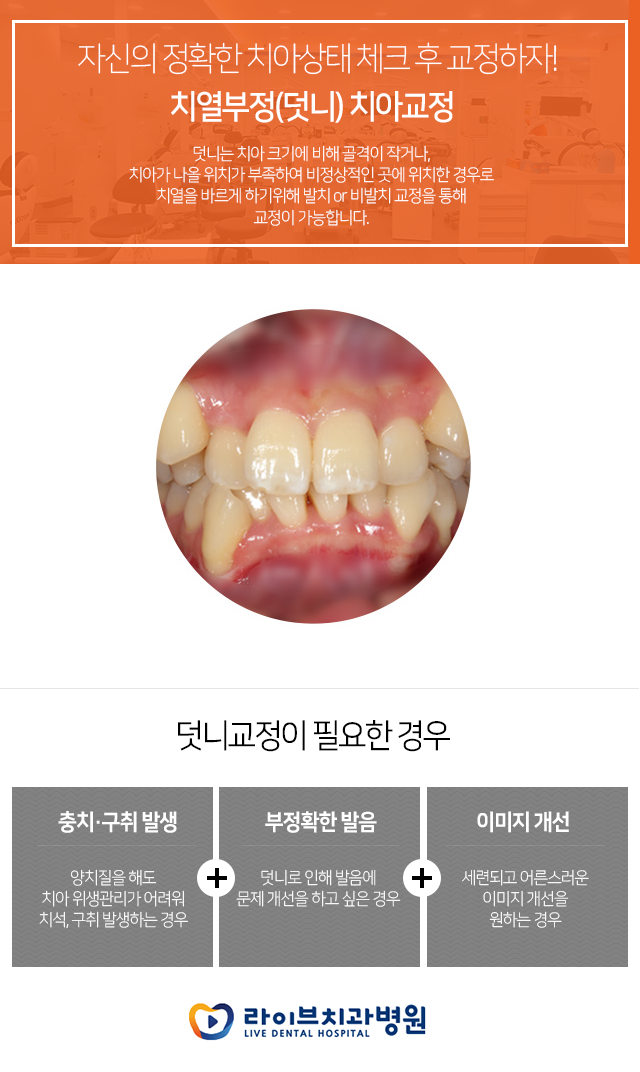 비발치교정 하나하나 알아보자~!! 관련 이미지 2