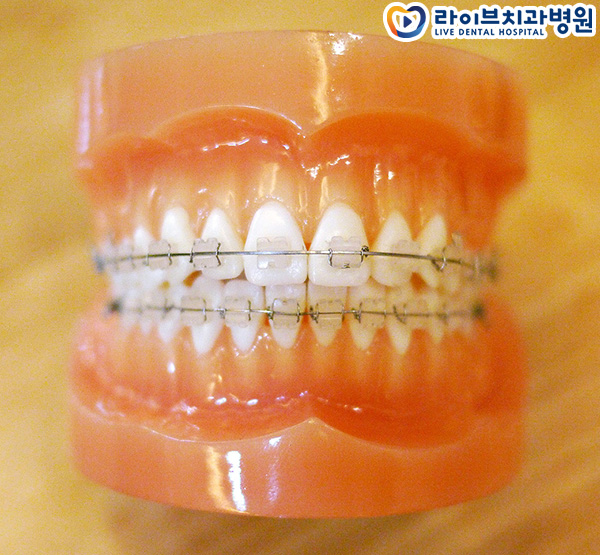 세라믹교정 많이 하시나요? 관련 이미지 3