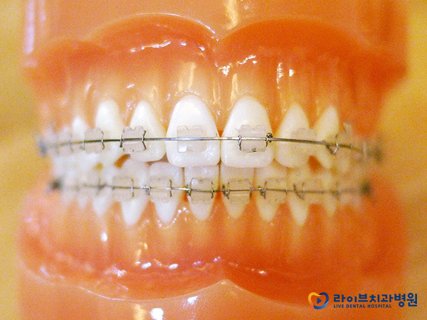 세라믹교정, 심미성을 높여 치료부담을 낮추다 관련 이미지 4