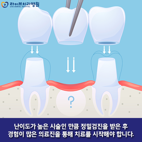 상악동거상술 궁금한 점에 대해 알아보자 관련 이미지 3