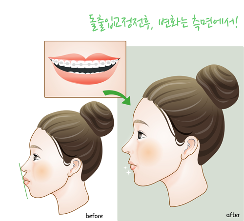 돌출입치아교정 이제 걱정하지마세요! 관련 이미지 4