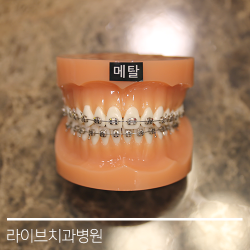 다양한 교정기의 종류들! 관련 이미지 3