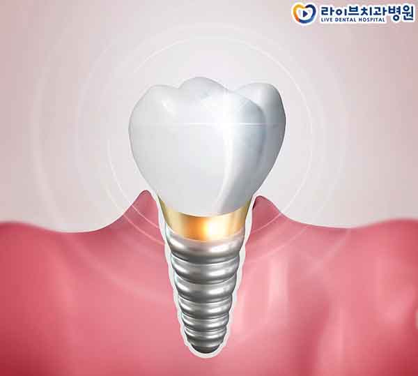 강남임플란트 어떻게 선택해야 할까요 관련 이미지 3