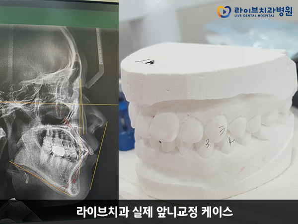 앞니교정, 앞니를 빠르게 개선하는 방법 관련 이미지 3