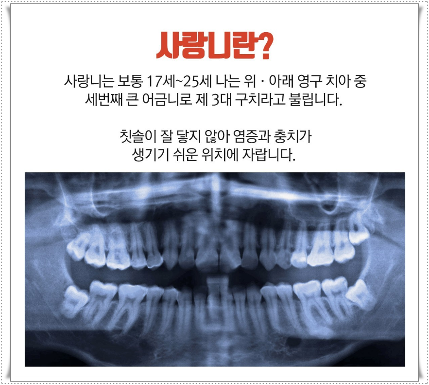 누운사랑니발치 매복된 사랑니 안뽑으면 안될까? 관련 이미지 2