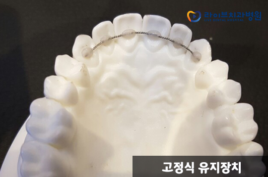 치아교정 유지장치, 왜 착용해야 할까? 관련 이미지 3