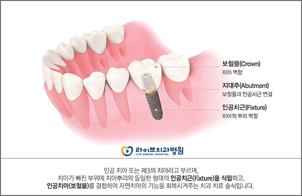 앞니임플란트 비용보다는 꼼꼼한 치료를! 관련 이미지 2