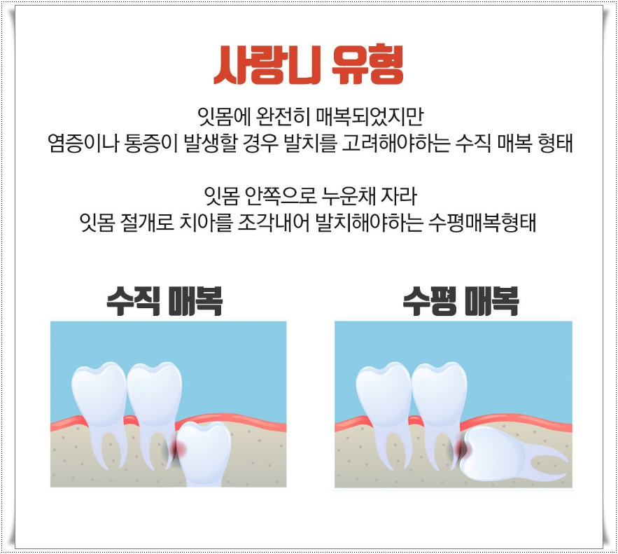 누운사랑니발치 매복된 사랑니 안뽑으면 안될까? 관련 이미지 4