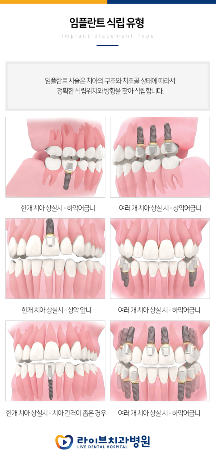 신사동 임플란트 받아야 한다면? 관련 이미지 2