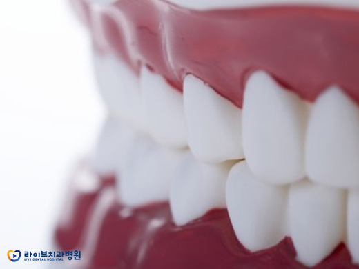 임플란트 수명을 연장하는 가장 좋은 방법은? 관련 이미지 2