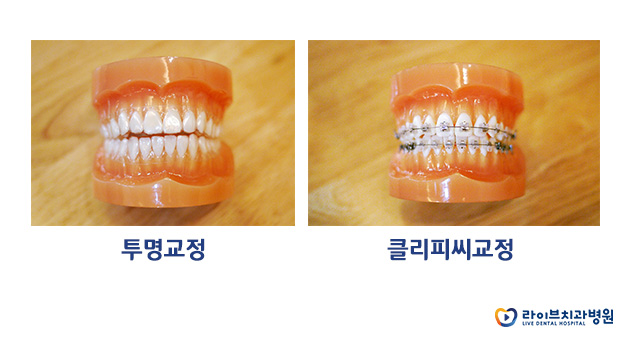 치아교정기간, 효과적으로 단축하자! 관련 이미지 3