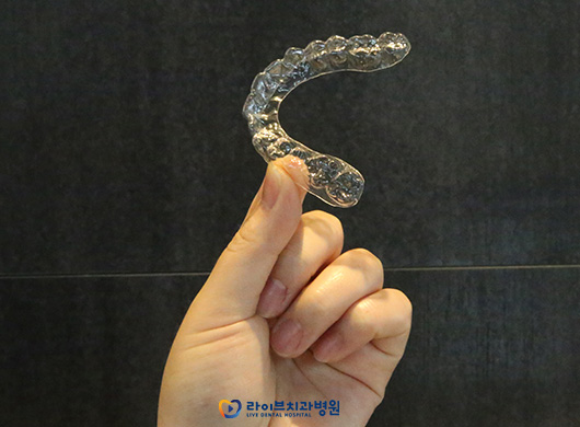 앞니교정, 부분교정으로 개선할 수 있을까? 관련 이미지 4