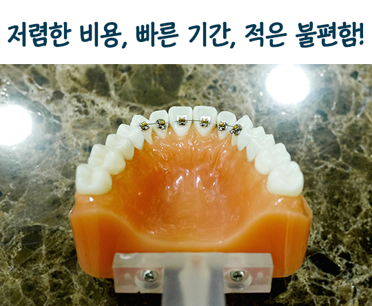 부분교정으로 편하게 교정하자! 관련 이미지 4