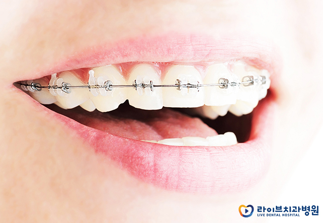 투명교정, 브라켓교정이 부담된다면? 관련 이미지 2