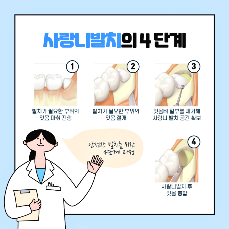 사랑니발치 뽑아야 할까요? 관련 이미지 3