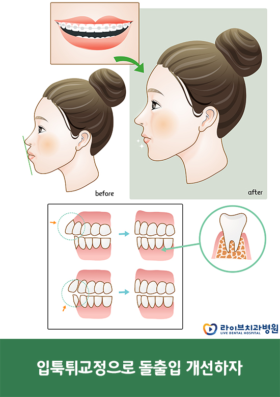 입툭튀교정 돌출입을 개선해보자 관련 이미지 6