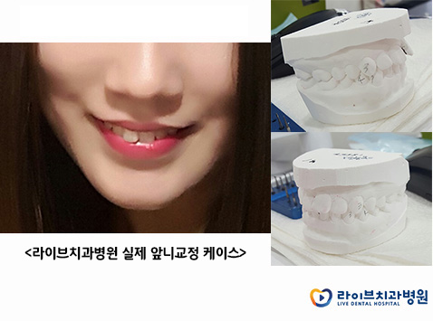 앞니교정, 필요한 부분만 쏘~옥! 관련 이미지 3