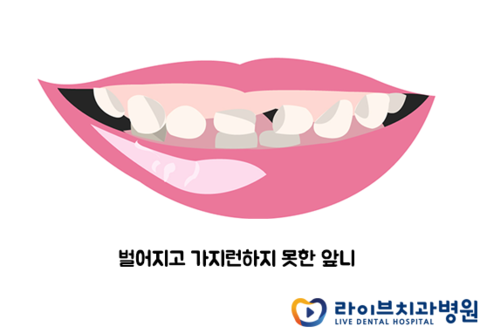 앞니교정, 절대 간단하지 않아요! 관련 이미지 2