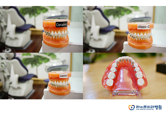 돌출입교정 잘하는 강남역치과는 어디? 관련 이미지 2