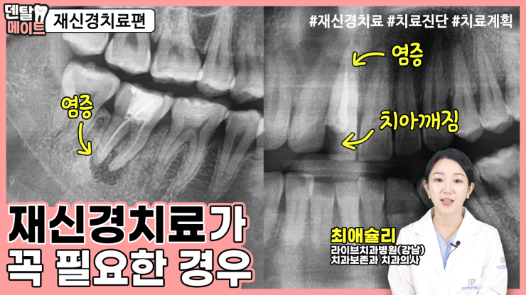 신경치료를 해도 통증이 있을 때! 재신경치료가 꼭 필요한 경우 관련 이미지 1