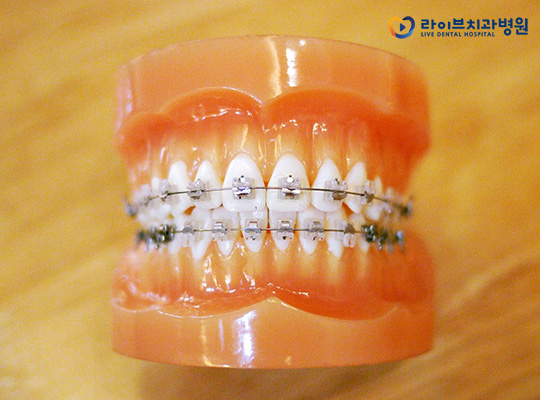 클리피씨교정, 대체 얼마나 만족스럽길래 관련 이미지 3