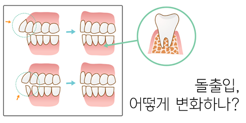 돌출입치아교정의 진행 과정과 효과에 대해! 관련 이미지 3