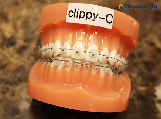 클리피씨교정, 치아교정기간 단축이 가능하다? 관련 이미지 3