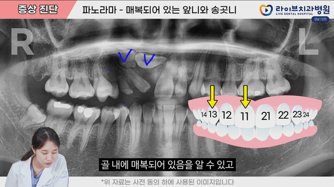 매복치를 동반한 부정교합 치료방법| 덴탈메이트 4탄 치아교정편 관련 이미지 2