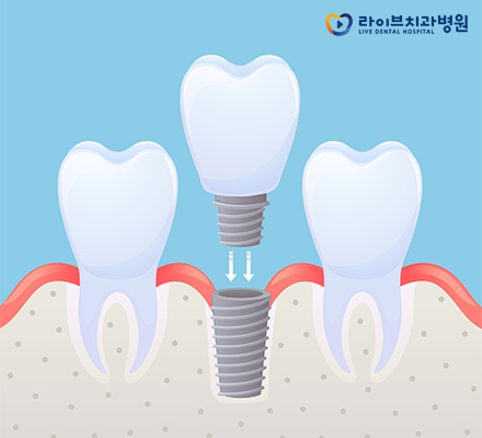 임플란트기간에 대한 모든 궁금증 타파! 관련 이미지 5