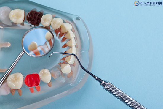 발치교정, 비발치교정이 결정되는 요인은? 관련 이미지 4