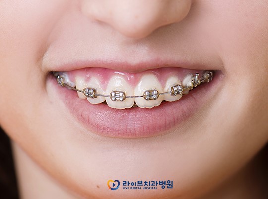 콤비교정, 위 아래 다른 스마트한 교정법! 관련 이미지 2