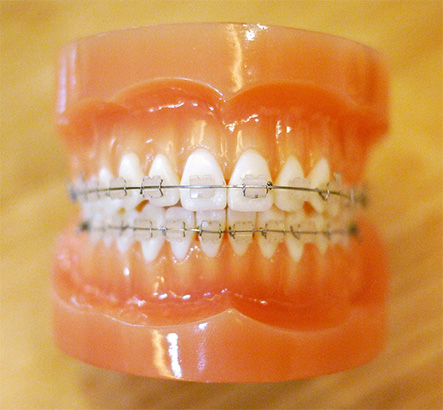 세라믹교정, 심미적으로 우수해요 관련 이미지 3