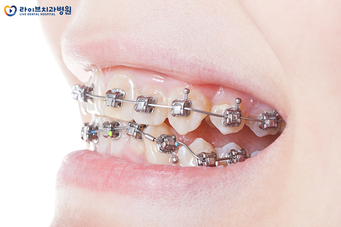 교정기 떨어지면 어떻게 하나요? 관련 이미지 3