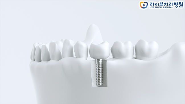 임플란트수명 오래 사용하기 위해선 관련 이미지 3