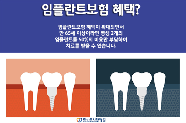 임플란트비용 보다 중요한 건? 관련 이미지 3
