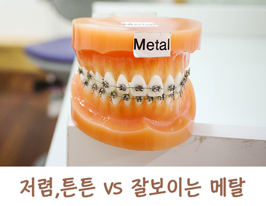 교정기의 종류에 대해 알아보자! 관련 이미지 2