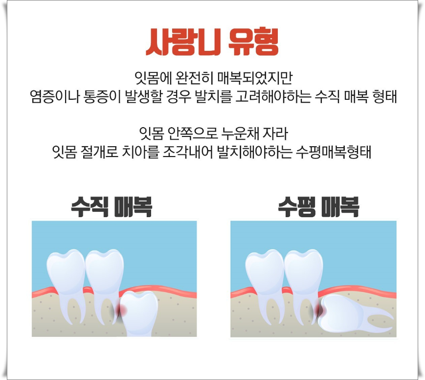 사랑니 유형과 발치 후 주의사항 정보 관련 이미지 4