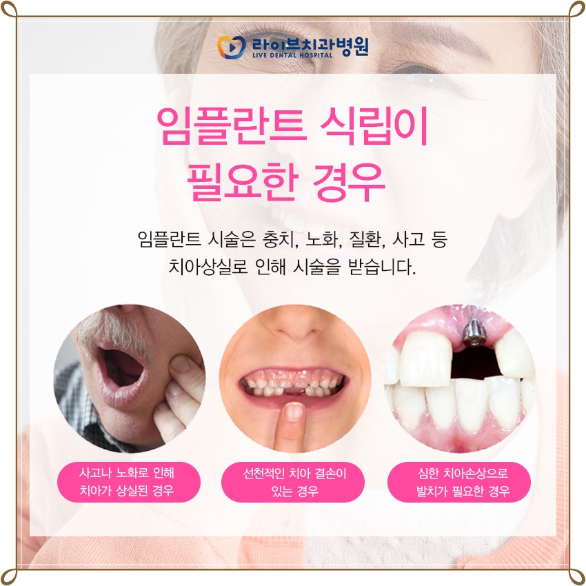 앞니임플란트가격 자연치아 회복이 우선! 관련 이미지 2