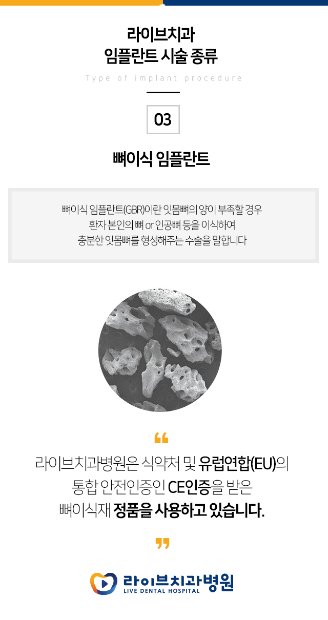 임플란트 재시술 받기 전에 잘 관리하자!!! 관련 이미지 2