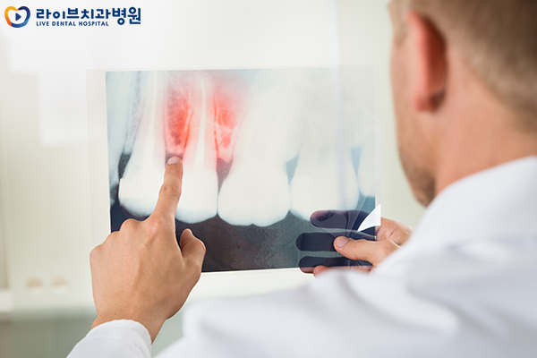 앞니임플란트 심미성을 되찾자 관련 이미지 3