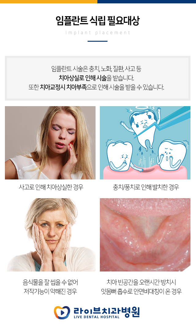 임플란트 종류가 있다는 사실 알고 계셨어요???? 관련 이미지 2