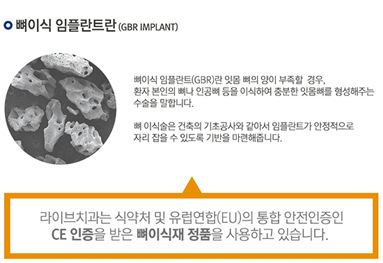 임플란트통증 많이 아플까요? 관련 이미지 4