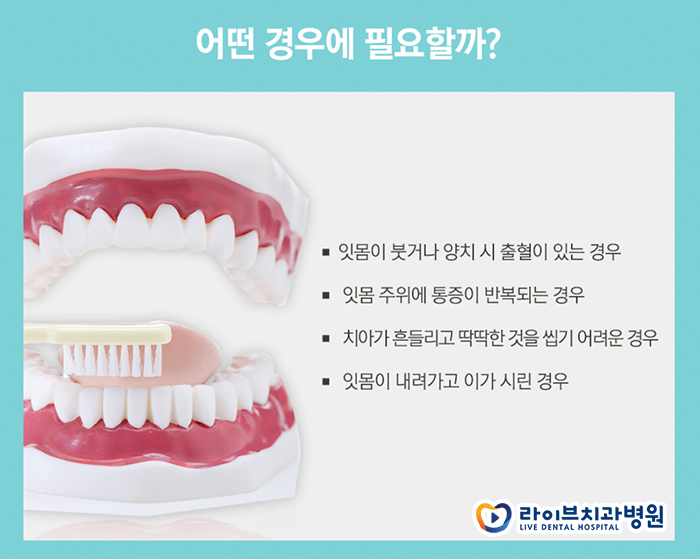 잇몸치료 방법 치료과정에 대해서 관련 이미지 3